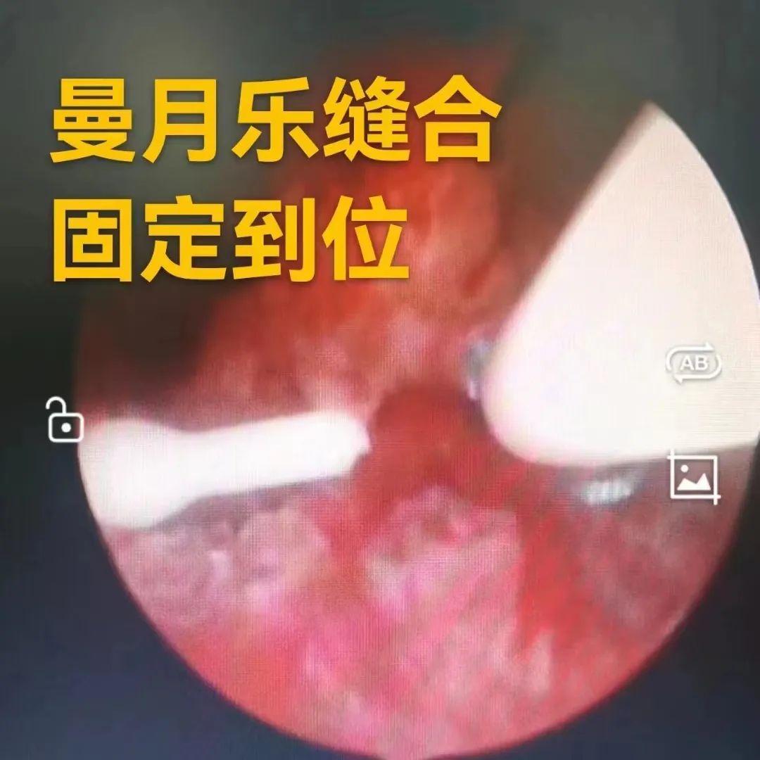 去医院上曼月乐环应该挂什么科（上曼月乐挂妇科还是计划生育科）