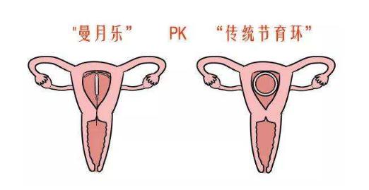 去医院上曼月乐环应该挂什么科（上曼月乐挂妇科还是计划生育科）